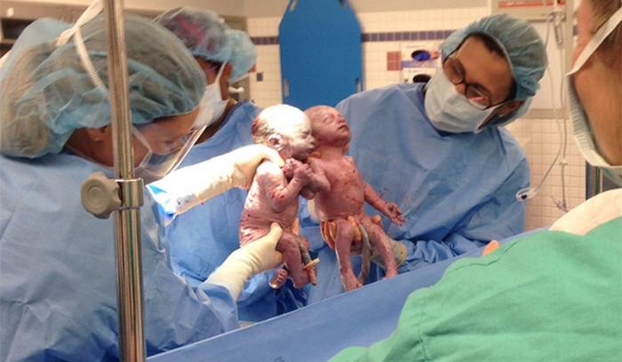 Ces jumelles sont nées en se tenant la main et 2 ans après, elles sont vraiment inséparables !