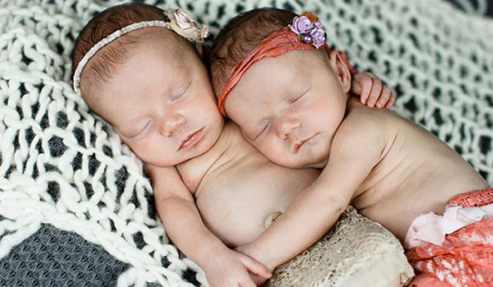 Ces jumelles sont nées en se tenant la main et 2 ans après, elles sont vraiment inséparables ! | #4